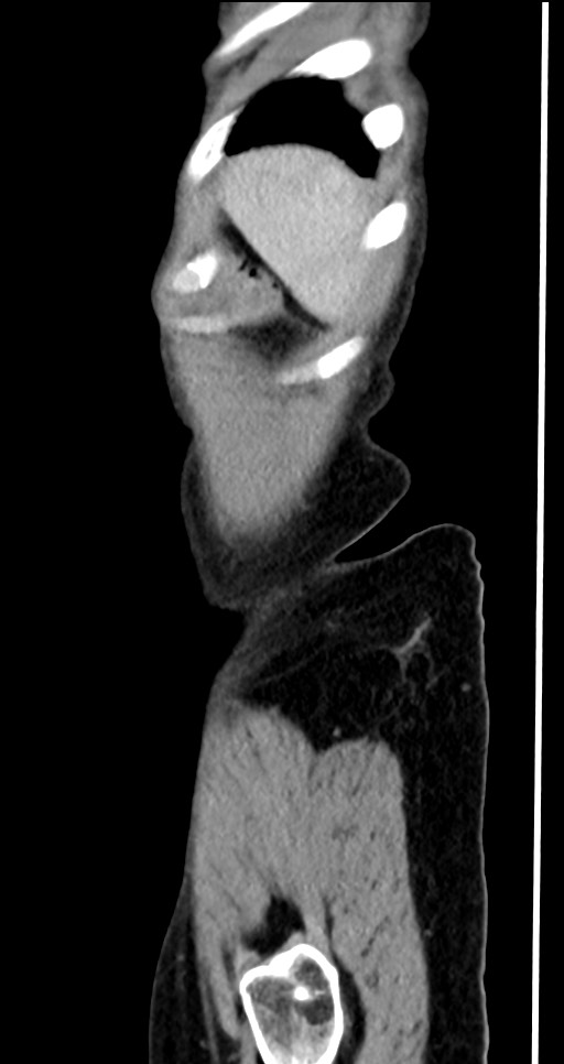 Abdominal wall and retroperitoneal tuberculosis (Radiopaedia 88137-104729 Sagittal C+ portal venous phase 16).jpg