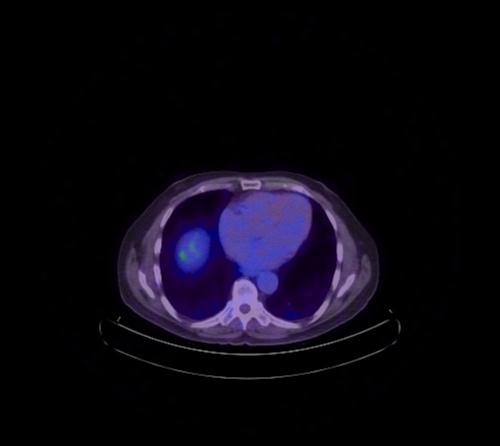 Abdominal wall metastasis from colorectal carcinoma (Radiopaedia 31016-31719 Axial 99).jpg