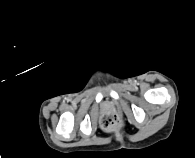 Abdominopelvic rhabdomyosarcoma (Radiopaedia 78356-90984 Axial C+ portal venous phase 155).jpg