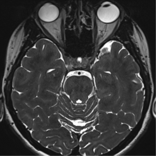 Abducens nerve palsy (Radiopaedia 51069-56648 Axial T2 fat sat 51).png