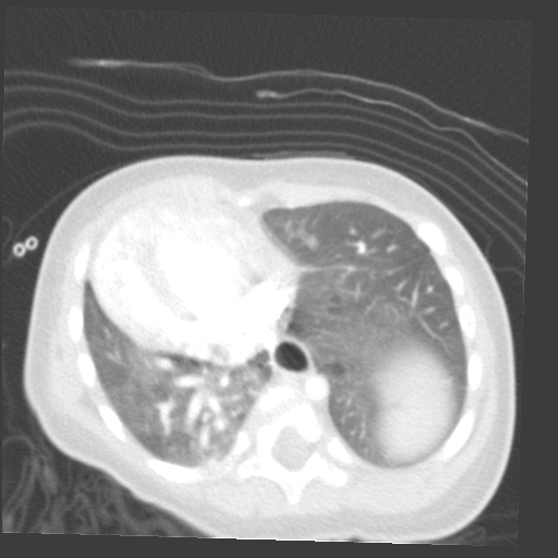 File:Aberrant left pulmonary artery (pulmonary sling) (Radiopaedia 42323-45435 Axial lung window 27).jpg