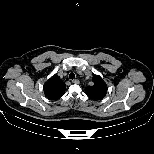 Aberrant right subclavian artery (Radiopaedia 87093-103354 Axial non-contrast 17).jpg