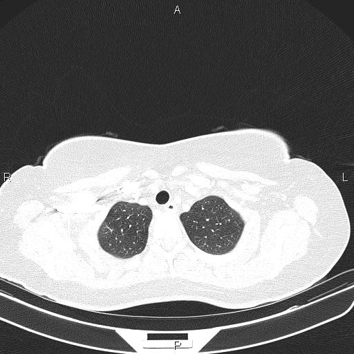 Aberrant right subclavian artery (Radiopaedia 87334-103629 Axial lung window 13).jpg