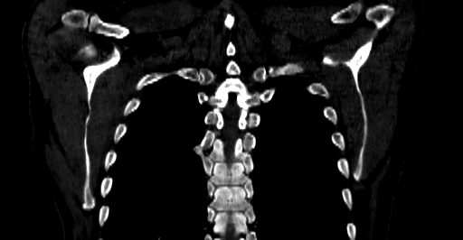 Accesory rib joint (Radiopaedia 71987-82452 Coronal bone window 55).jpg
