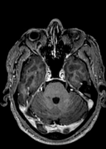Accessory middle cerebral artery (Radiopaedia 73114-83828 Axial T1 C+ 110).jpg