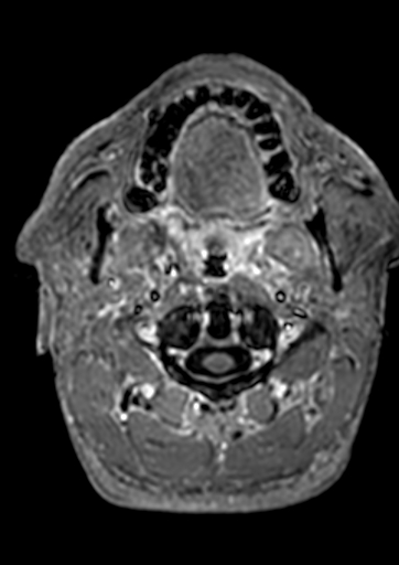Accessory middle cerebral artery (Radiopaedia 73114-83828 Axial T1 C+ 225).jpg
