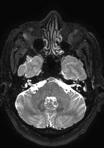 Accessory middle cerebral artery (Radiopaedia 73114-83828 Axial T2 165).jpg