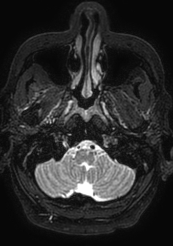 Accessory middle cerebral artery (Radiopaedia 73114-83828 Axial T2 206).jpg