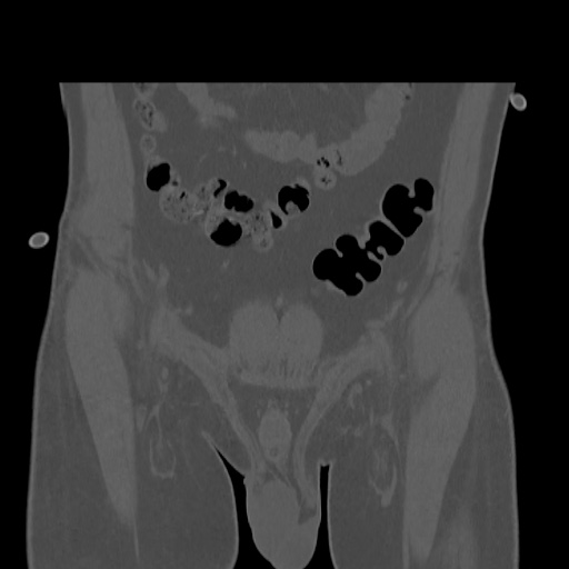 Acetabular and ilial fractures (Radiopaedia 59084-66378 Coronal bone window 7).jpg