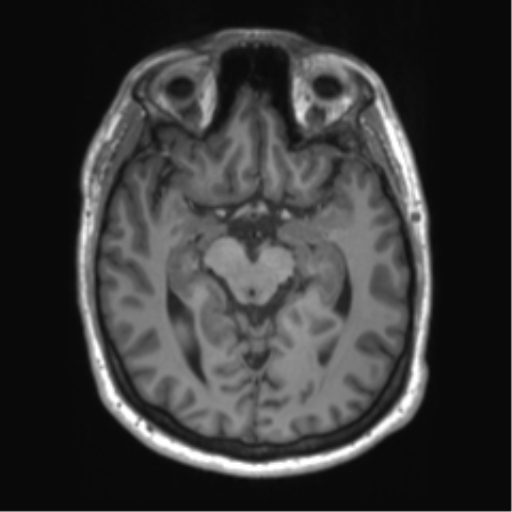File:Achondroplasia (Radiopaedia 65109-74105 Axial T1 33).png