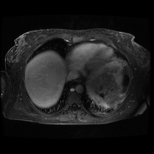 Acinar cell carcinoma of the pancreas (Radiopaedia 75442-86668 D 132).jpg