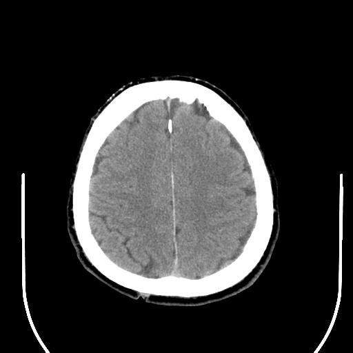 File:Acoustic schwannoma (Radiopaedia 29488-29982 AXIAL THICK non-contrast 39).jpg