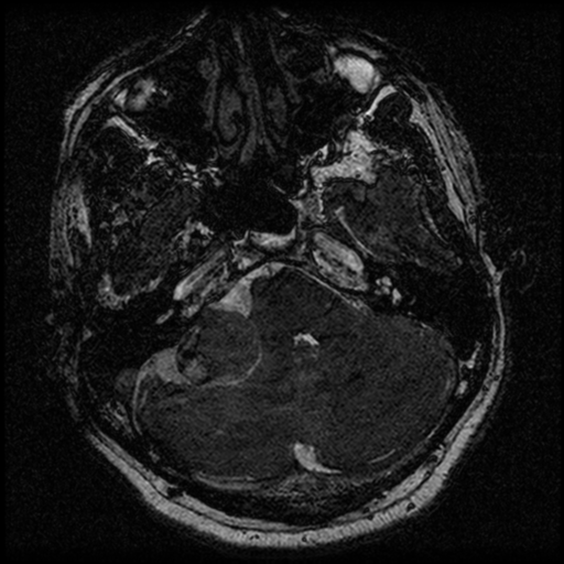 File:Acoustic schwannoma (Radiopaedia 39170-41387 Axial FIESTA 60).png
