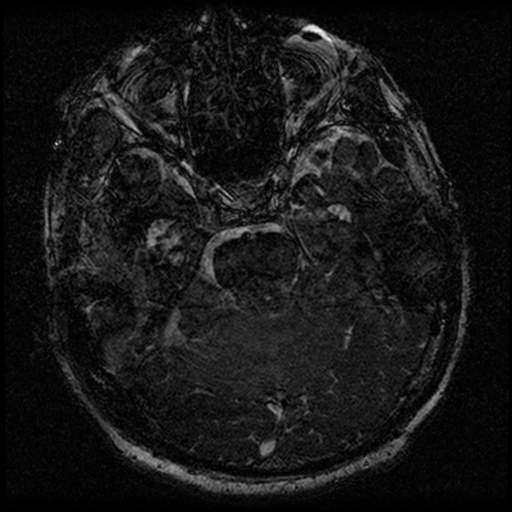 File:Acoustic schwannoma (Radiopaedia 39170-41387 Axial FIESTA 98).png