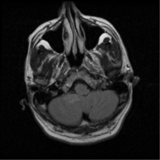 File:Acoustic schwannoma (Radiopaedia 39170-41387 Axial FLAIR 3).png