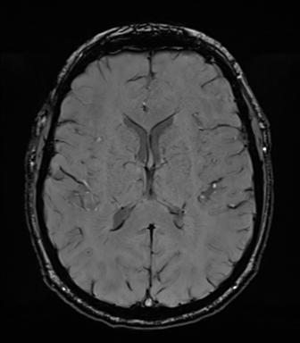 File:Acoustic schwannoma (Radiopaedia 50846-56358 Axial SWI 54).png