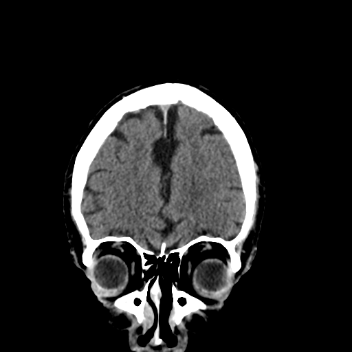 File:Acoustic schwannoma (Radiopaedia 55729-62280 Coronal non-contrast 10).png