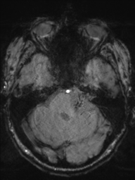 Acoustic schwannoma (Radiopaedia 55729-62281 Axial SWI 14).png