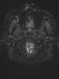 File:Acoustic schwannoma (Radiopaedia 55729-62281 Axial SWI 56).png