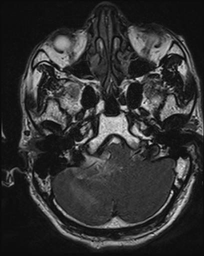 Acoustic schwannoma - probable (Radiopaedia 20386-20292 Axial T1 29).jpg
