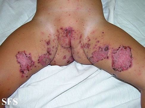 File:Acrodermatitis Enteropathica (Dermatology Atlas 22).jpg