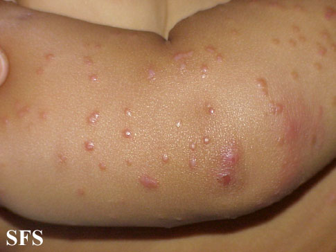 File:Acrodermatitis Infantile Papular (Dermatology Atlas 15).jpg