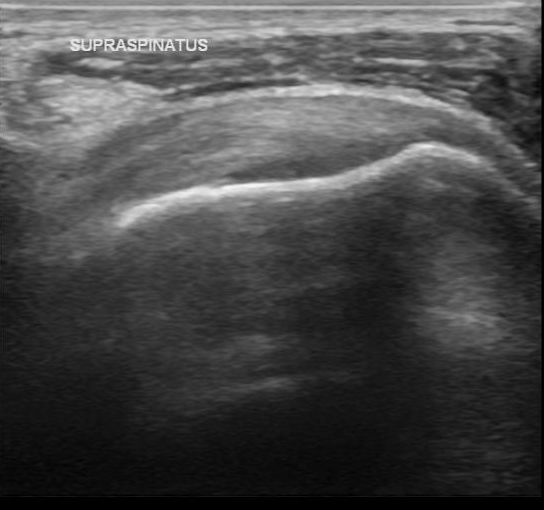 File:Acromial fracture - ultrasound (Radiopaedia 26729-26891 F 1).jpg
