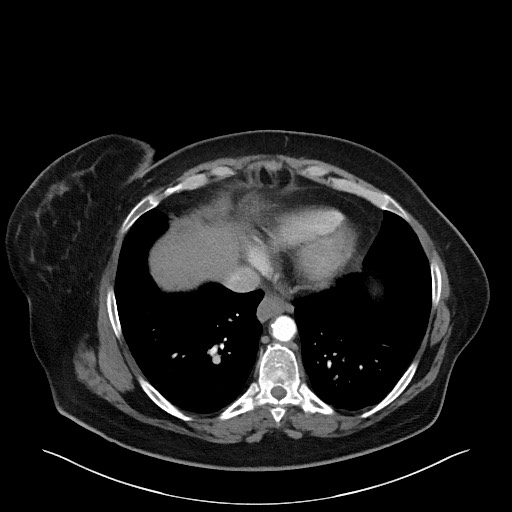 Acromioclavicular joint cyst (Radiopaedia 58455-65610 Axial C+ arterial phase 77).jpg