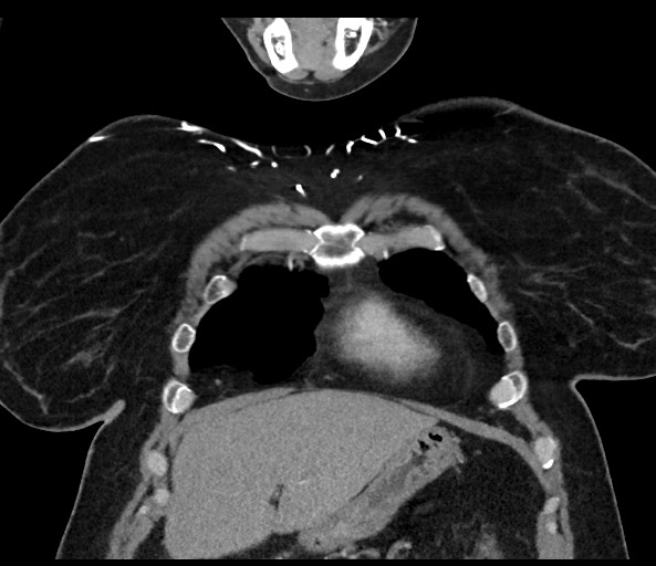 Acromioclavicular joint cyst (Radiopaedia 58455-65610 Coronal C+ arterial phase 37).jpg
