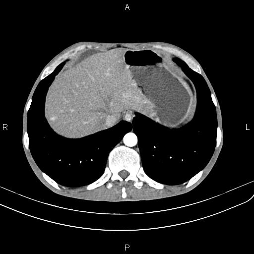 Active crohn disease (Radiopaedia 87133-103397 Axial C+ arterial phase 15).jpg