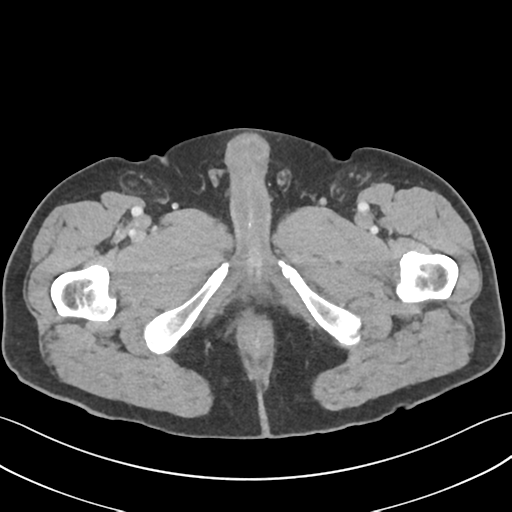 File:Active diverticular hemorrhage (Radiopaedia 39415-41725 Axial C+ portal venous phase 80).png