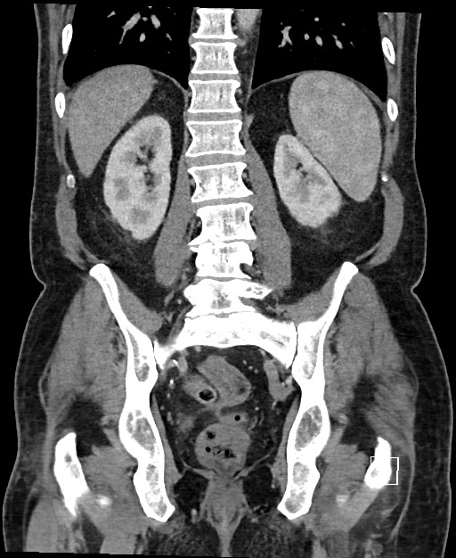 Active lower gastrointestinal bleeding - diverticular (Radiopaedia 61203-69106 Coronal C+ portal venous phase 95).jpg