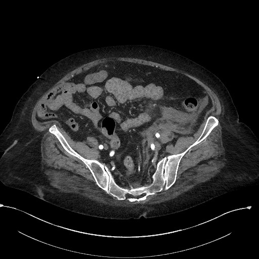 Active renal extravasation with large subcapsular and retroperitoneal hemorrhage (Radiopaedia 60975-68796 Axial C+ arterial phase 147).jpg