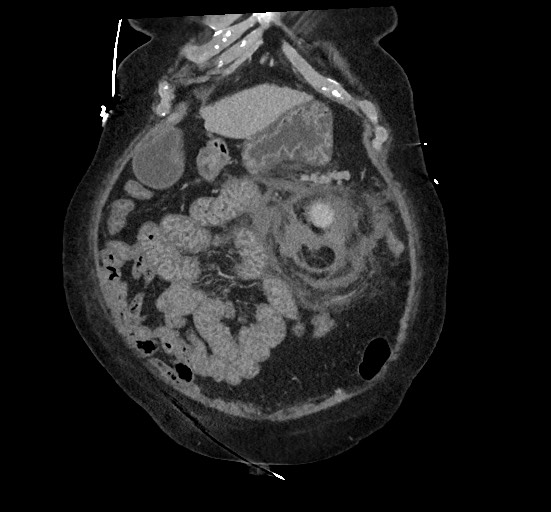 Active renal extravasation with large subcapsular and retroperitoneal hemorrhage (Radiopaedia 60975-68796 Coronal C+ portal venous phase 41).jpg