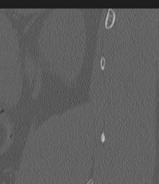File:Acute L1 burst compression fracture (Radiopaedia 34430-35755 Sagittal bone window 60).png