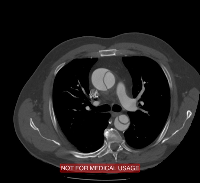 Acute aortic dissection - Stanford type A (Radiopaedia 40661-43285 Axial C+ arterial phase 19).jpg