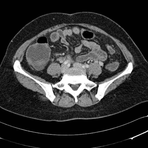 File:Acute appendicitis (Radiopaedia 48792-53822 Axial C+ portal venous phase 77).jpg