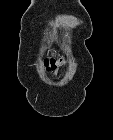 File:Acute appendicitis (Radiopaedia 48792-53822 Coronal C+ portal venous phase 22).jpg