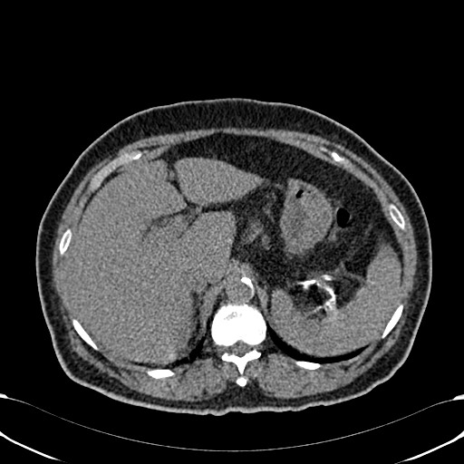 Acute appendicitis (Radiopaedia 58627-65818 Axial non-contrast 22).jpg