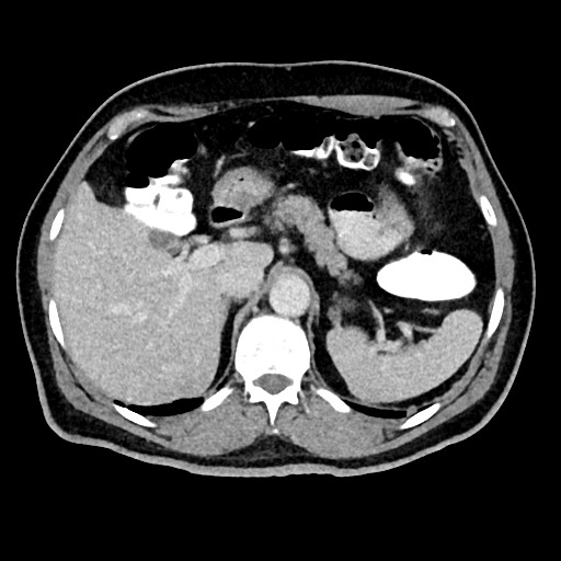 Acute appendicitis (Radiopaedia 77016-88960 Axial C+ portal venous phase 38).jpg