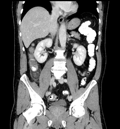 Acute appendicitis (Radiopaedia 77016-88960 Coronal C+ portal venous phase 56).jpg