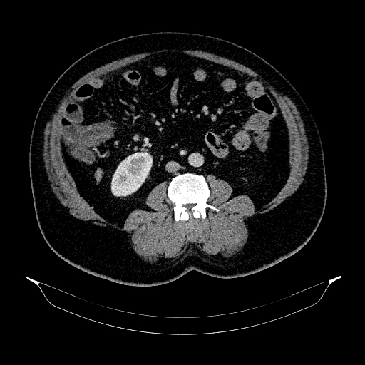 File:Acute appendicitis (Radiopaedia 79950-93224 Axial C+ portal venous phase 56).jpg