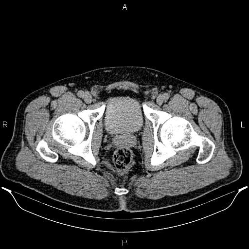 File:Acute appendicitis (Radiopaedia 84780-100240 Axial C+ delayed 106).jpg