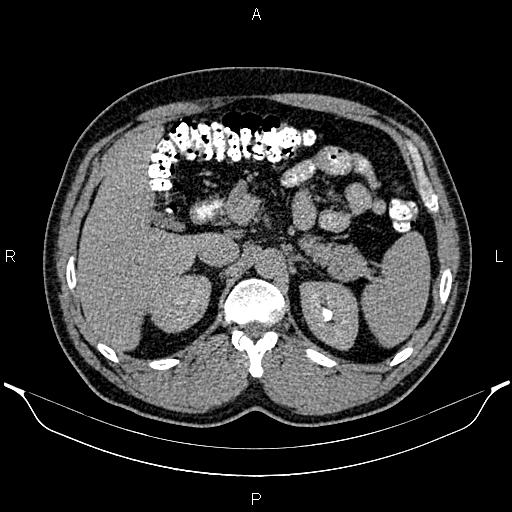Acute appendicitis (Radiopaedia 84780-100240 Axial C+ delayed 32).jpg