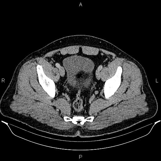 Acute appendicitis (Radiopaedia 84780-100240 Axial C+ portal venous phase 95).jpg