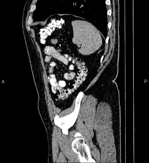 Acute appendicitis (Radiopaedia 84780-100240 Sagittal C+ portal venous phase 90).jpg