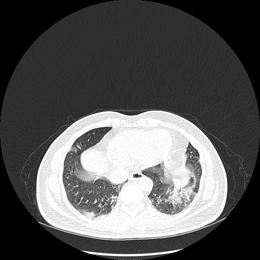 Acute appendicitis and COVID 19 pneumonia (Radiopaedia 76604-88380 Axial lung window 42).jpg
