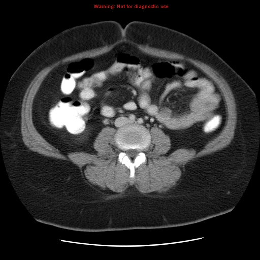 Acute appendicitis complicated by ovarian vein thrombophlebitis (Radiopaedia 16172-15851 Axial C+ portal venous phase 54).jpg