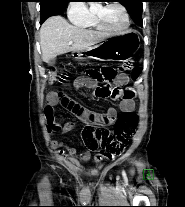 Acute arterial mesenteric ischemia (Radiopaedia 78238-90828 Coronal C+ portal venous phase 33).jpg
