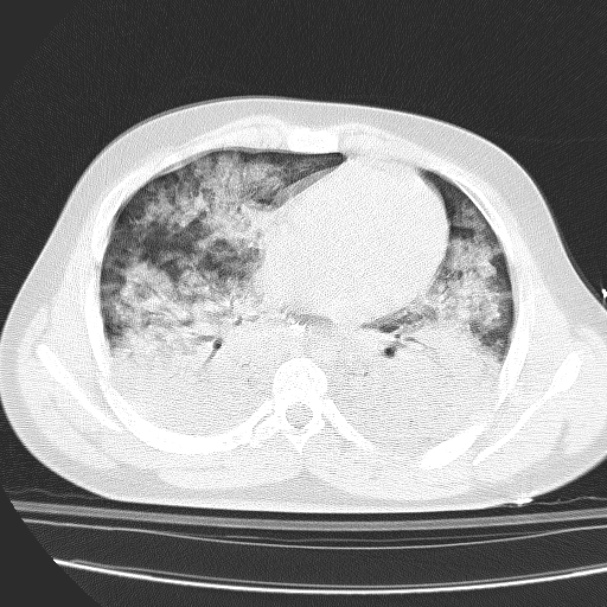 Acute aspiration pneumonitis (Radiopaedia 33605-34703 Axial lung window 60).jpg